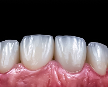 Emax Veneers Multilayer