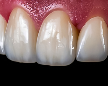 Emax Veneers (Full Anatomy)
