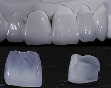 Feldspathic veneers