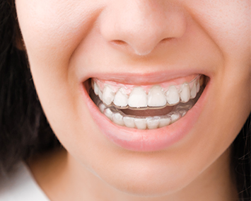 التقويم الشفاف القابل للإزالة (Invisalign)